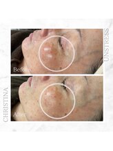 シャルムパリス(charme paris)/１回の施術変化