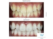 ホワイトニングショップ 山口店/山口ホワイトニング