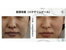 トレゾール(tresor)/★毛穴★30代（たるみ/くすみ）