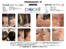 シール(Syl)/プロセルセラピーズ症例
