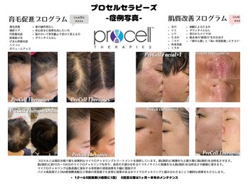 シール(Syl)/プロセルセラピーズ症例
