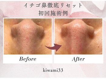 キワミ サーティスリー(kiwami33)/毛穴洗浄でたまった汚れリセット
