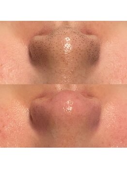 ミューズ(MUSE)/毛穴エクストラクション