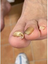 フットメンテ 巻き爪矯正センター 南浦和/巻き爪