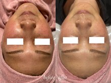 ティアラッシュ(TiaLash)/光フェイシャル