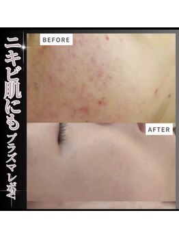 オリーブ(Olive)/ニキビやニキビ跡の改善に