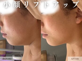 レヴェリー 心斎橋店(REVERIE)/‐ あご下お肉取り ‐