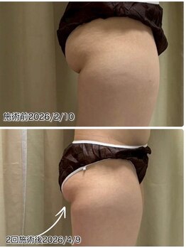 クールスパ(COOL SPA)/【20代女性】ヒップ症例