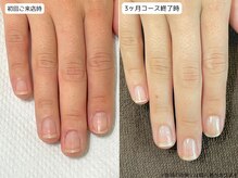 カピリナ(Ka Pilina)/自爪育成・川崎・深爪