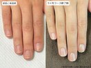 自爪育成・川崎・深爪