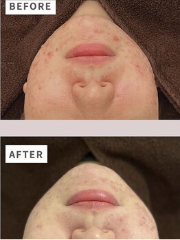 アイル 玉造店(iru)/ニキビケアにハーブピーリング