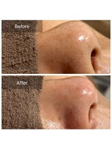 ディーキャットリー(D Catrry)/ごっそり小鼻の黒ずみ