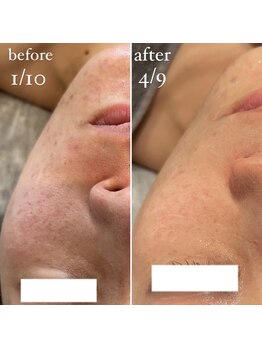 エクラ(eclat)/しみ、毛穴にアプローチ！