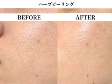 サンビ(SANBI)/開き毛穴撃退！！