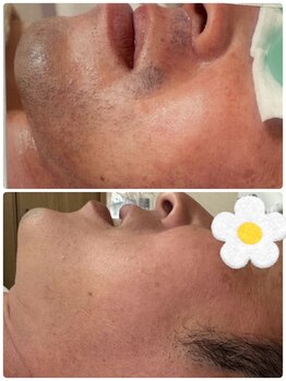 ティアレ 廿日市店(Tiare)/髭脱毛　ひげ