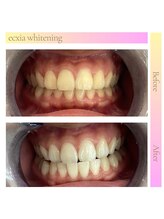エクシアホワイトフジ(ecxia white fuji)/ホワイトニングサロン　富士市