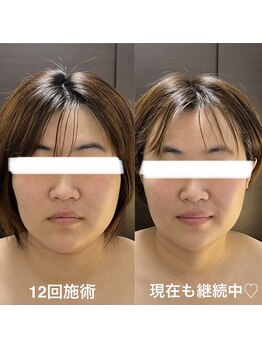 ソラ(sola*)/小顔コルギ90分 12回~継続中