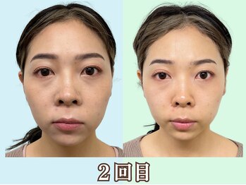 ナチュラルパーフェクトフェイス 新宿/タルミもスッキリ改善/新宿小顔