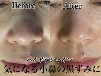 アンドエス 六本木(and S.)/気になる小鼻の黒ずみに毛穴洗浄
