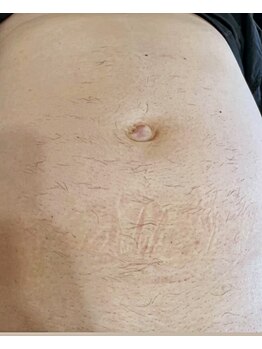 ディスイズミー(This is ME)/男性 お腹 1回