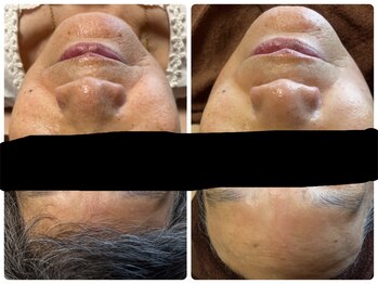 ルポ(Ropos)/ハーブピーリング