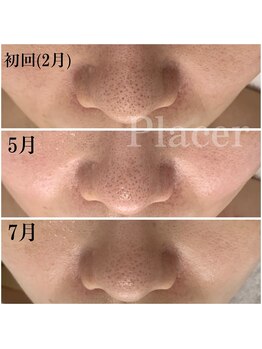 プラセル(Placer)/毛穴はすぐには改善できない