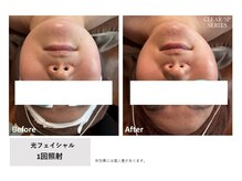 ロカビリー(Rockabilly)/レディース　光フェイシャル