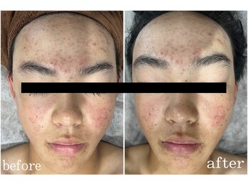 サロン ラズリ 久留米店(SALON Lazuli)/【オプション炭酸ガスパック】