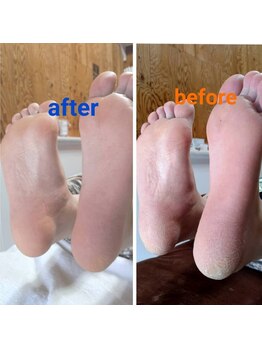 ラナ(Lana)/福津市 角質ケア ☆