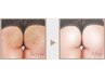 ビキニを着る前に!!【お尻ニキビケア】　ニキビ×ニキビ色素沈着部分的￥5500