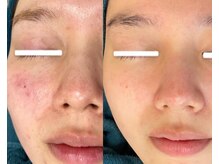 エヌ(N)/ハーブピーリングでの変化