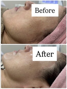 ペルボヌール 深井店/美肌＆小顔メニュー