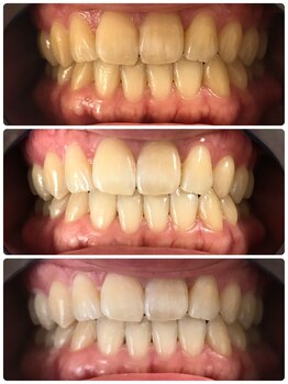 グリッター ショウナン(glitter. SHONAN)/藤沢ホワイトニングbefore/after