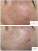 ユニ(uni.)/ハーブピーリング症例