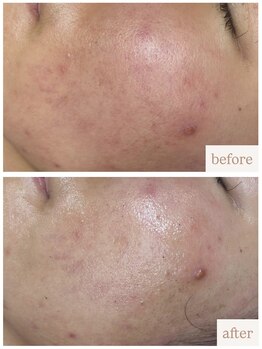 ユニ(uni.)/ハーブピーリング症例