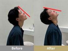 せなかのはね 難波心斎橋店/10代 首こり 頭痛 手の痺れ