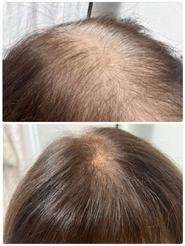 ニューユー(NewYou)/ノアグロウスカルプ