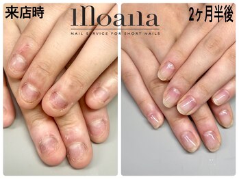 モアナ 池袋(MOANA)/激変!美爪に大変身!