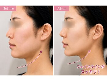 リフト 静岡(Lift)の写真/【顔のもたつきを撃退】韓国式小顔マシン、マイクロリフトで脂肪に直接アプローチ!結果重視の最新小顔矯正