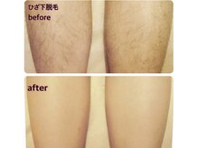 ラウレア 松山店(LAULEA)/つるすべ素足を自慢しちゃおう！