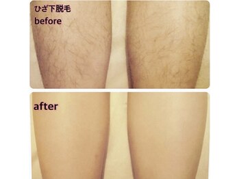 ラウレア 松山店(LAULEA)/つるすべ素足を自慢しちゃおう！