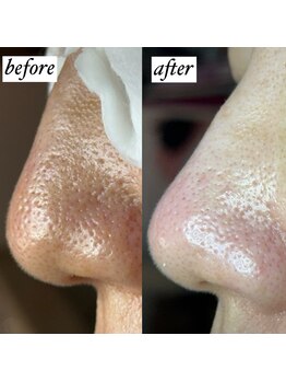 ライカブルー(RaicA BluE)/施術写真 before-after