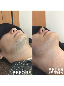 リズム(LISM)/ヒゲ2回照射後