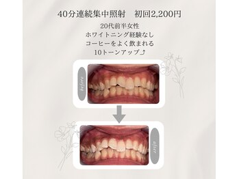 プラスビーセルフ(+b self)/ホワイトニングビフォーアフター