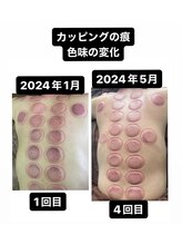 リベル(Liber)/リンパマッサージからカッピング