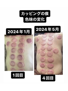 リベル(Liber)/リンパマッサージからカッピング