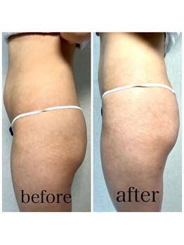 ブランカ ナガサキ(BLANCA NAGASAKI)/1回でぽっこりお腹をひきしめ