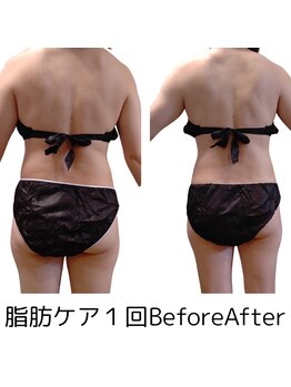 フロレゾン(Floraison)/ヒップ・太ももの脂肪ケア