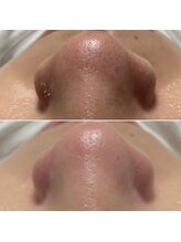 ノーブル 上土店(Noble)/毛穴洗浄BeforeAfter