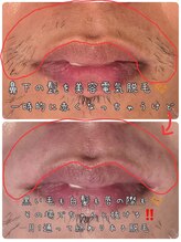 ベビースキン(baby skin)/美容電気脱毛